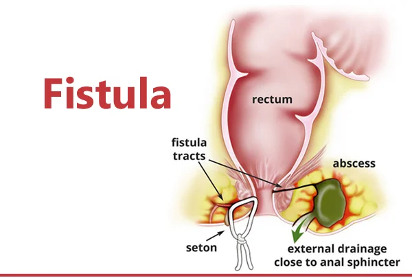 Fistula