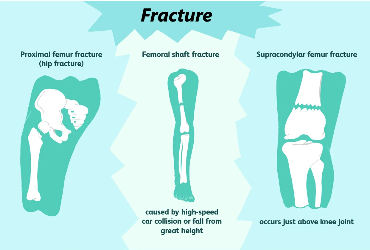 Fracture