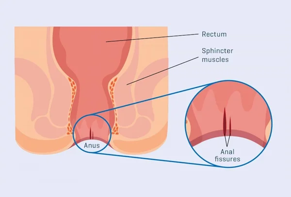 Fissure