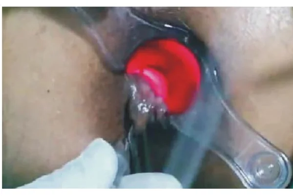 Laser Proctology
